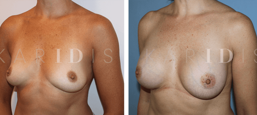 Breast enhancement surgery results