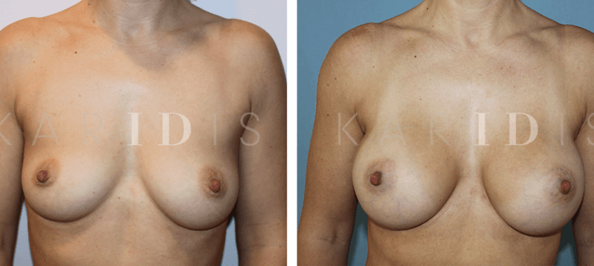 Breast enhancement surgery with implants