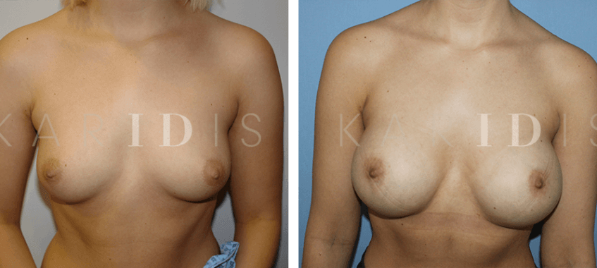 Breast enlargement with implants