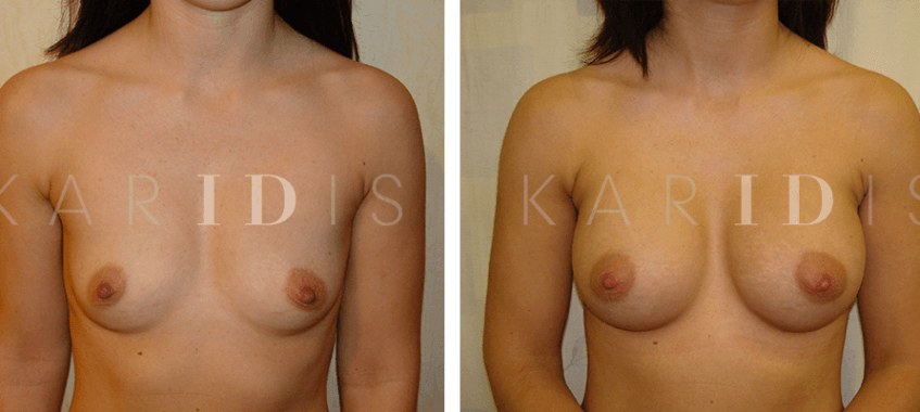 Breast enlargement with implants before and afters