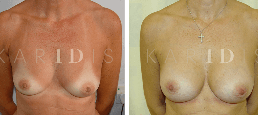 Breast implant surgery before and afters