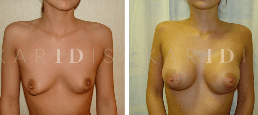 Breast implant surgery before and afters