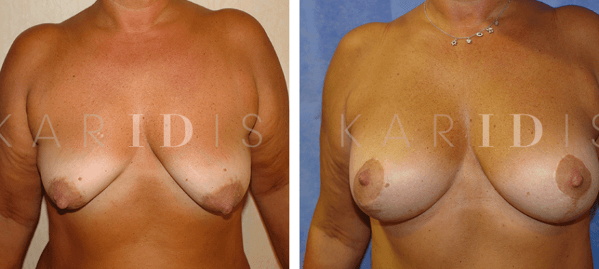 Breast implants combined with breast uplift results