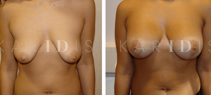 Breast implants combined with breast uplift results