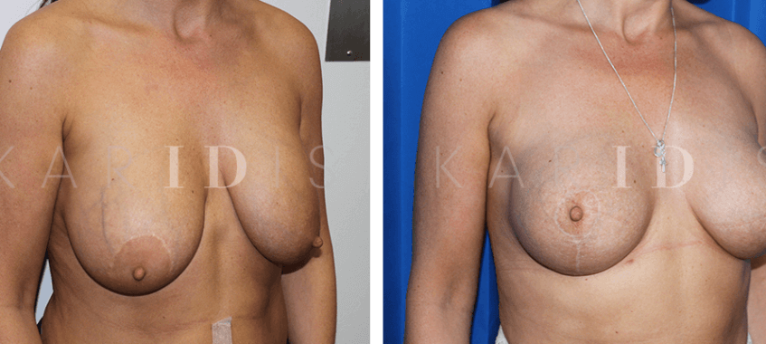 Breast implants combined with breast uplift results