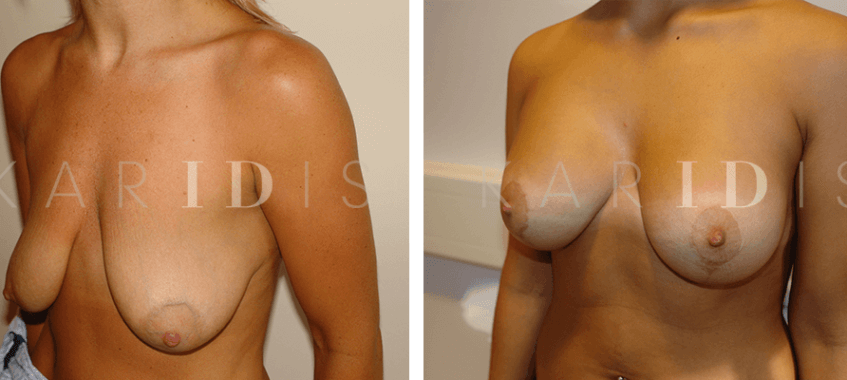 Breast lift with implants before and afters