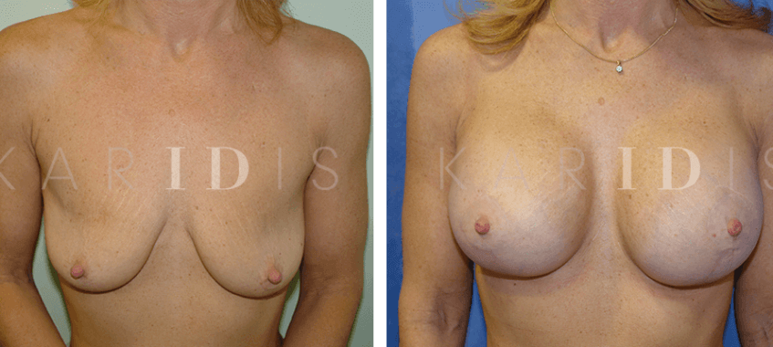 Breast uplift and augmentation results