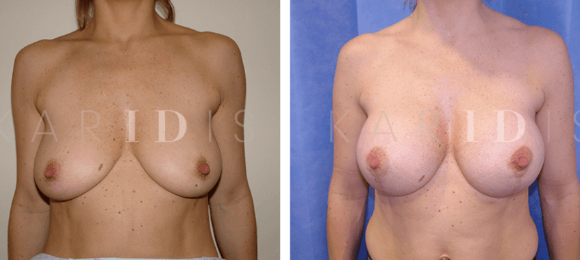 Breast uplift and breast augmentation combined