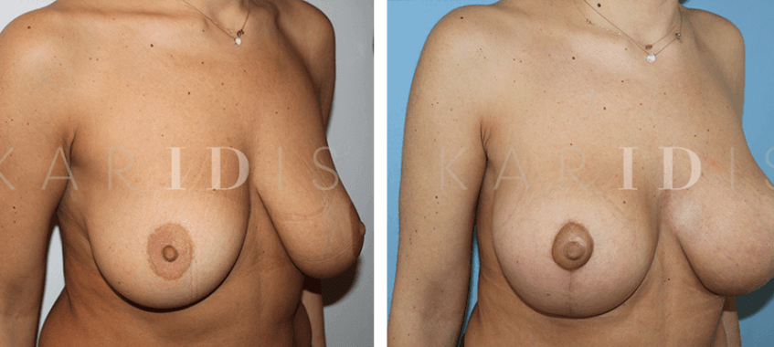 Breast uplift combined with breast implants before and afters