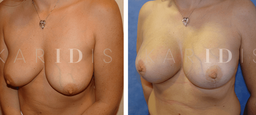 Breast uplift combined with breast implants before and afters