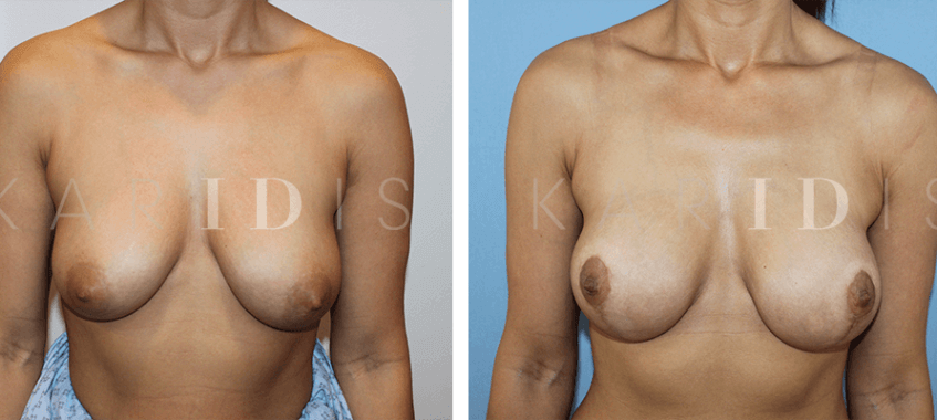 Breast uplift with implants