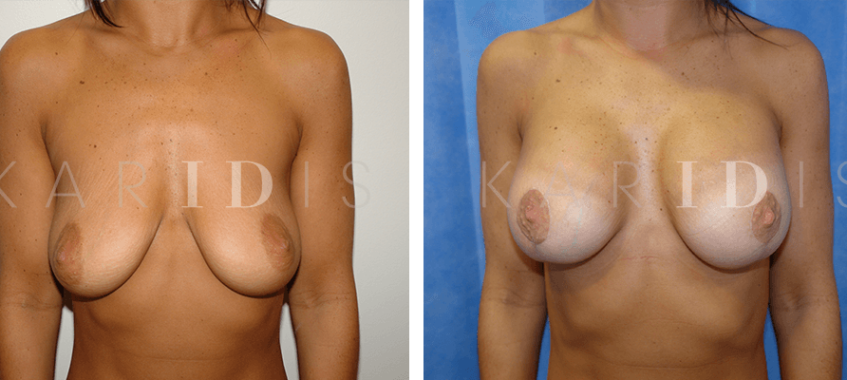 Breast uplift with implants results