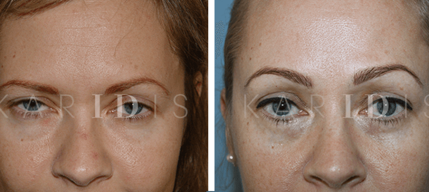 Brow lift results after ten years