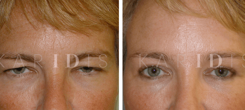 Brow lift with upper blepharoplasty
