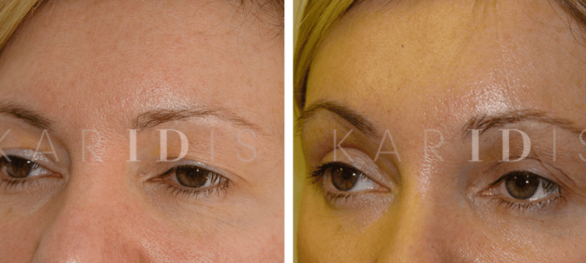 Brow lift with upper blepharoplasty surgery