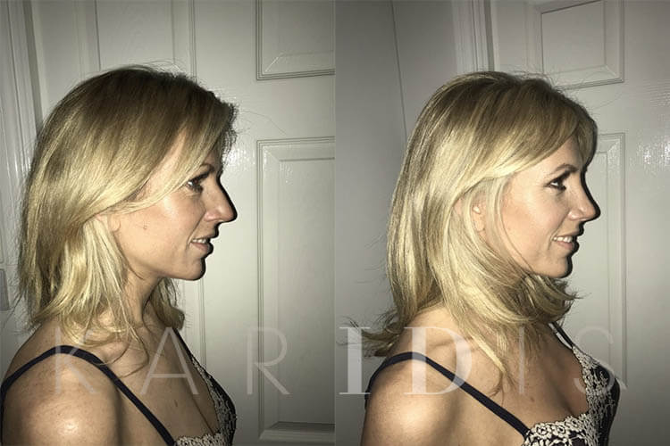 Charlotte Rhinoplasty Before and After Side