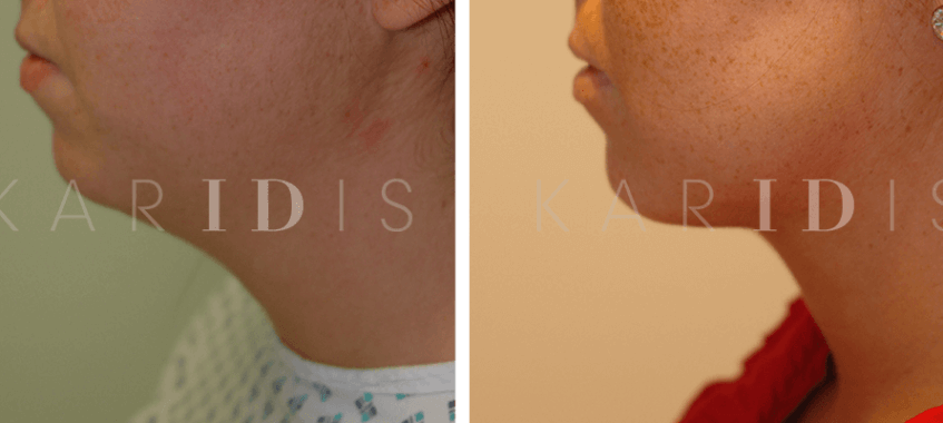 Chin liposuction before and afters