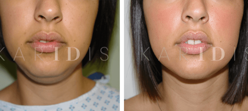 Chin liposuction before and afters