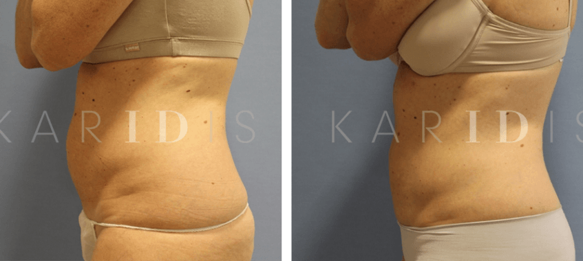 CoolSculpting Fat Reduction on Abdomen