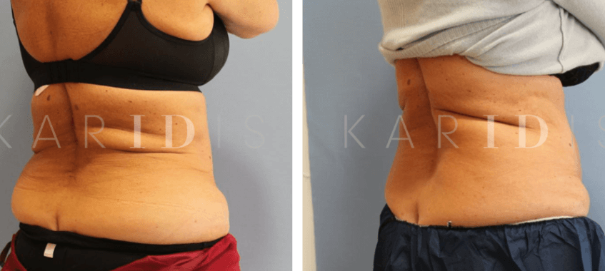 CoolSculpting Fat Reduction on Back