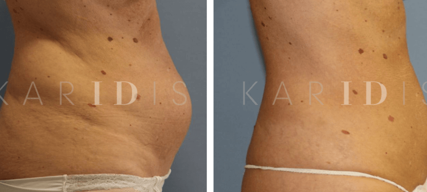 CoolSculpting Fat Reduction on Lower Abdomen