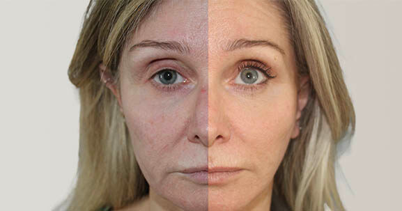 Deep plane facelift before and after
