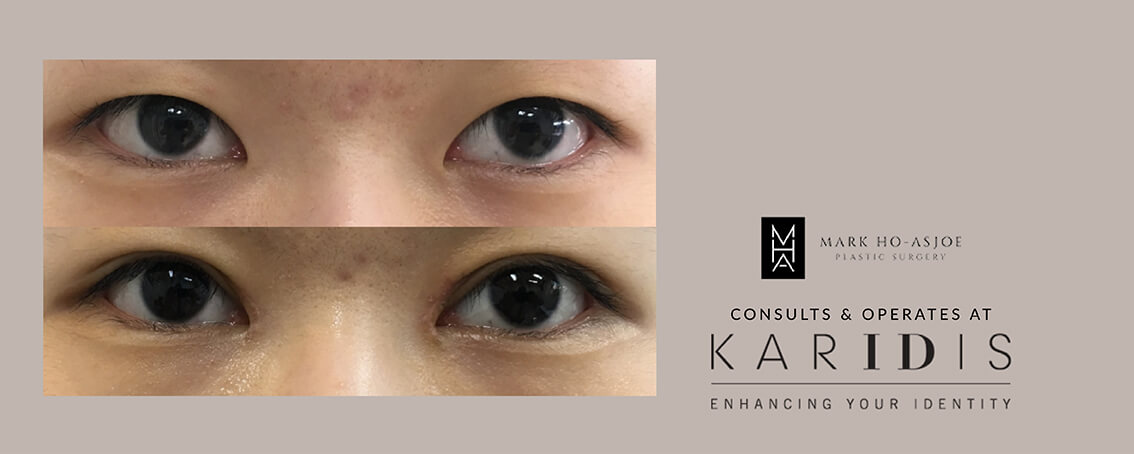 Double Eyelid Surgery by Mr Mark Ho-Asjoe at Karidis Clinic