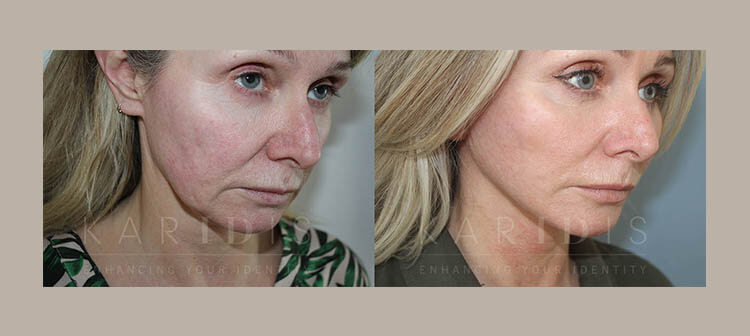 Emma Reed Facelift Story