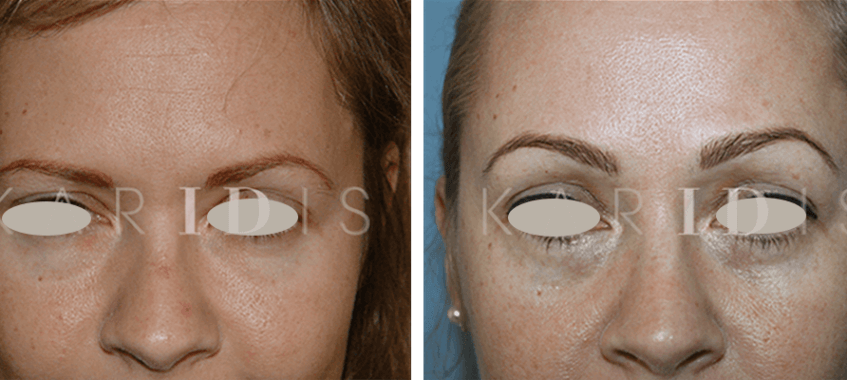 Eyebrow Lift Before and Afters