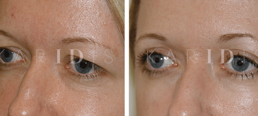 Eyelid Lift Before and Afters