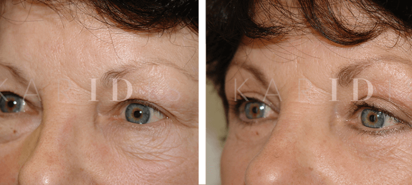 Eyelid Surgery Results