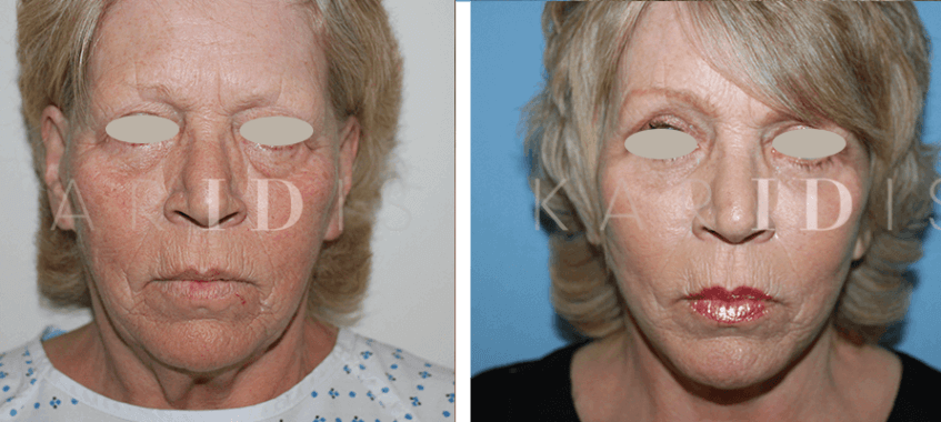 Facelift Before and Afters