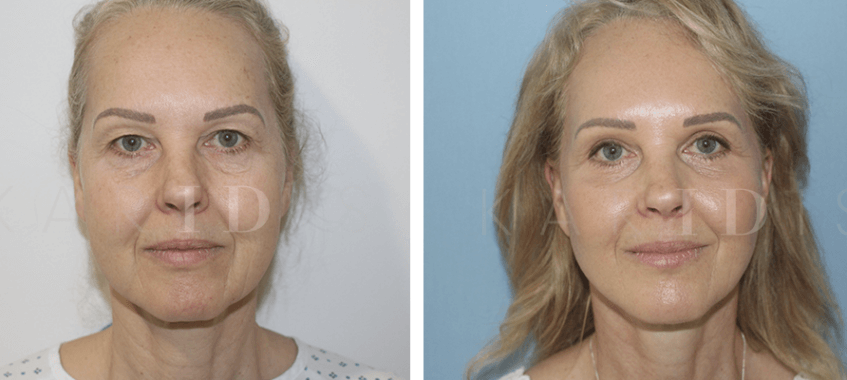 Facelift Before and Afters