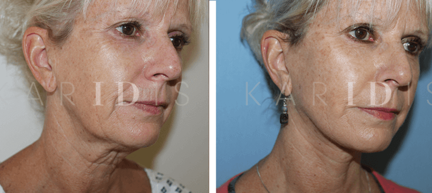 Facelift Before and Afters