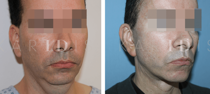 Facelift Before and Afters pixelated