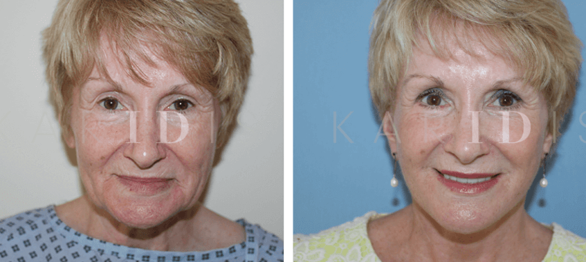 Facelift Results
