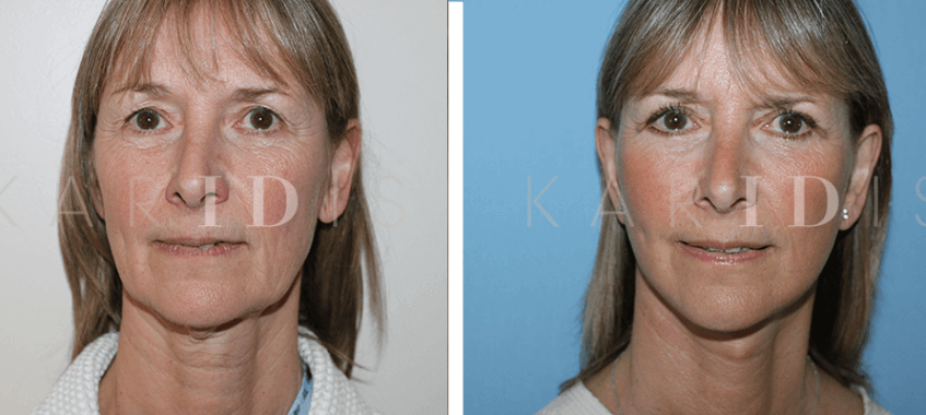 Facelift Surgery Results