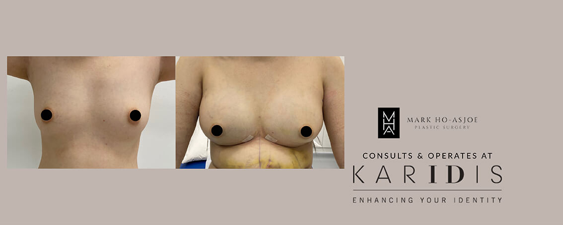 Fat Transfer to Breasts by Mr Mark Ho-Asjoe at Karidis Clinic