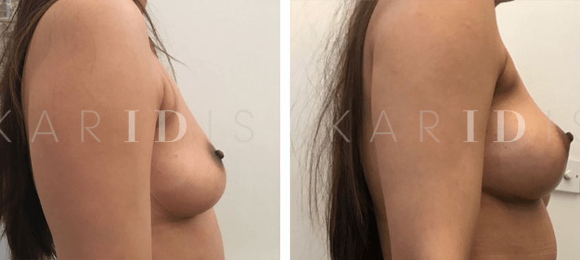 Fat Transfer to the Breasts London