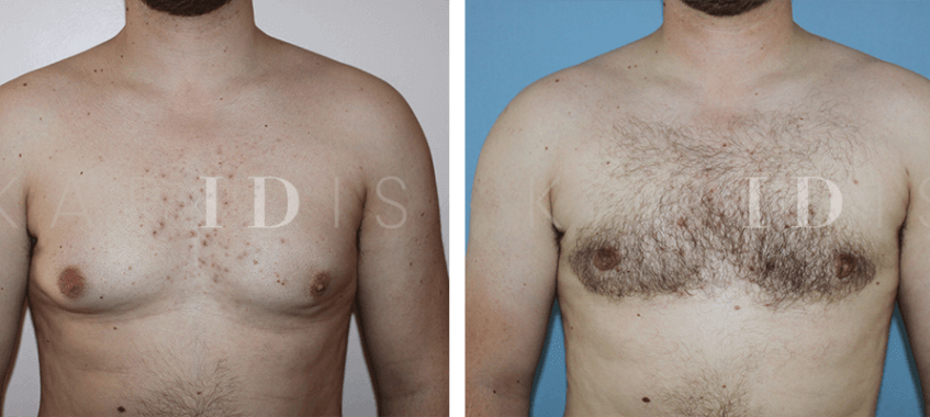 Gynaecomastia Surgery London Results