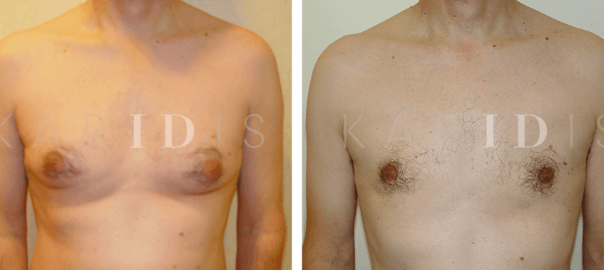 Gynaecomastia Surgery Results