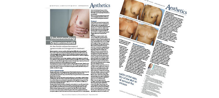 Gynaecomastia covered in Aesthetic Journal