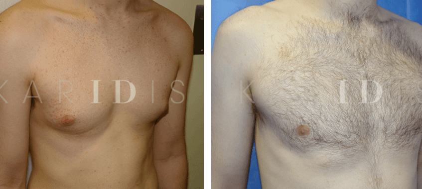 Gynecomastia Surgery London Results