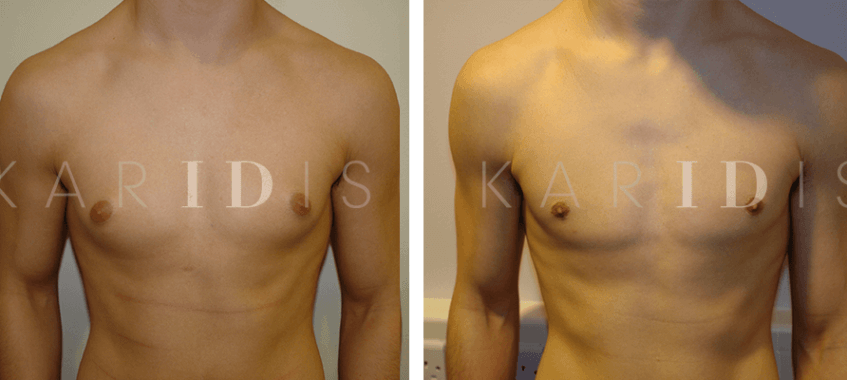 Gynecomastia Surgery Results