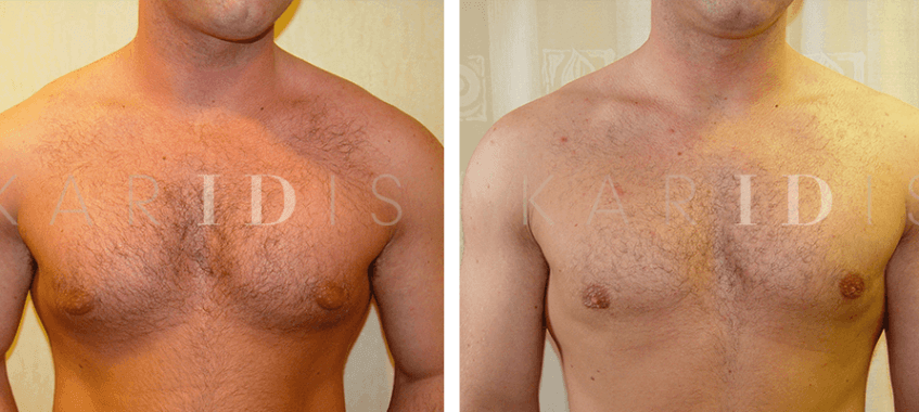 Gynecomastia Surgery Results