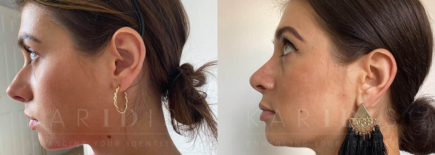 Holly Rhinoplasty Results