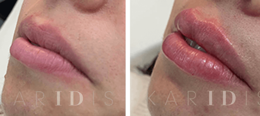 Lip Augmentation