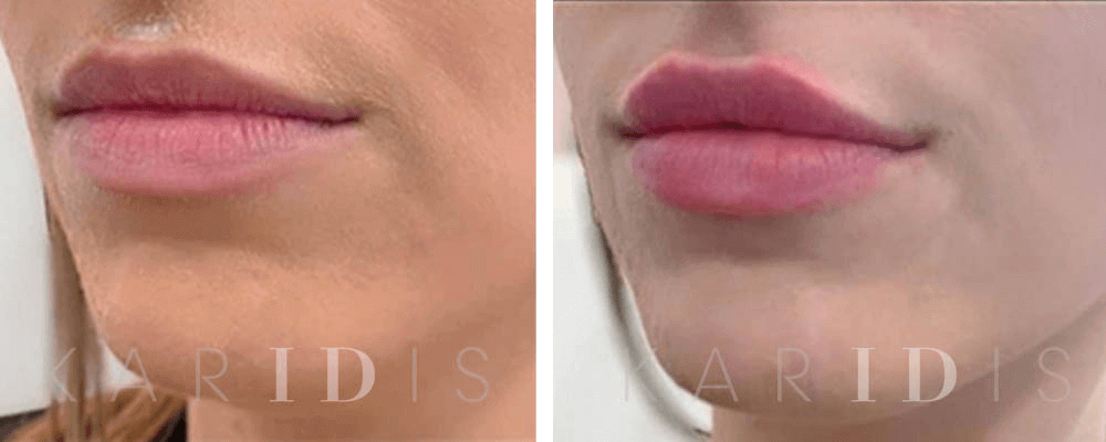 Lip Augmentation Before and Afters