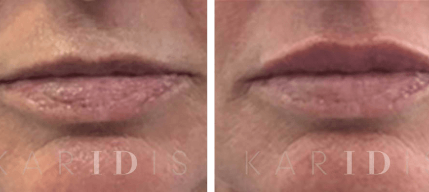 Lip Augmentation with Fillers