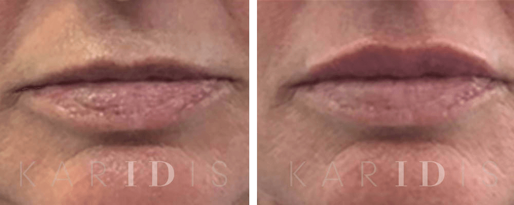 Lip Augmentation with Fillers